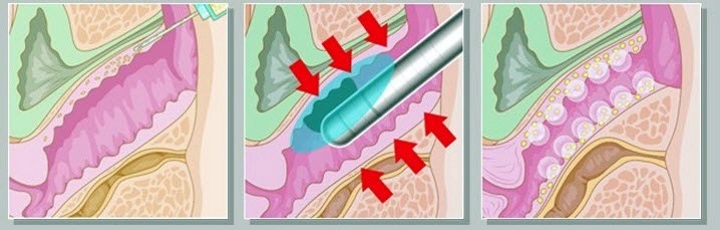 HiFu behandling vagina